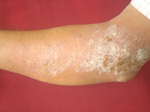 Eczema known in medical terms as Dermatitis is an inflammation of the skin.