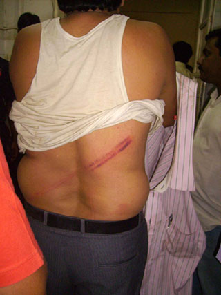 An activst showing wound of lathicharge by Police